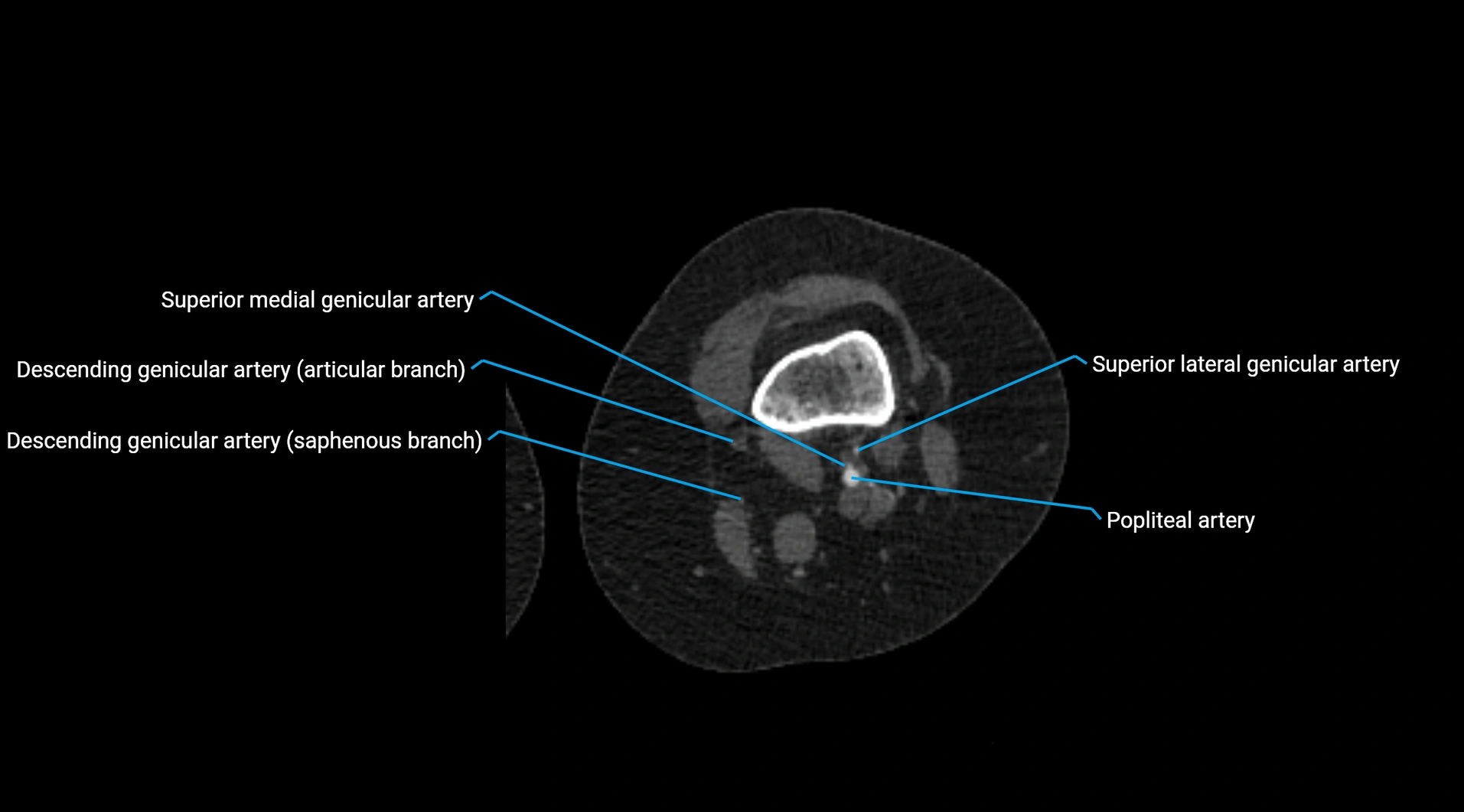 CTA lower limb cross sectional anatomy labelled image _166.webp